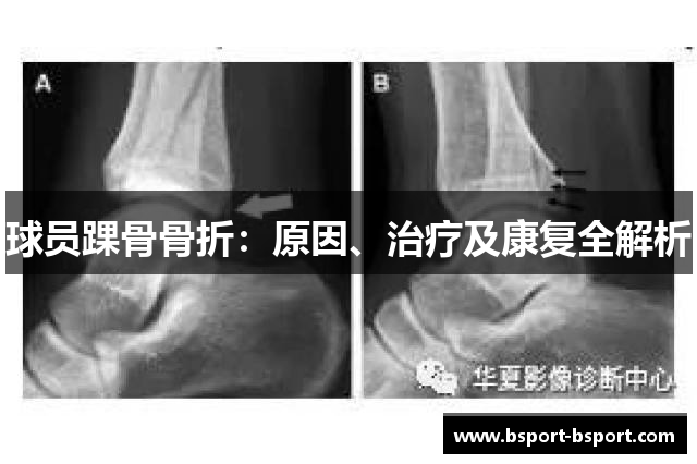 球员踝骨骨折：原因、治疗及康复全解析